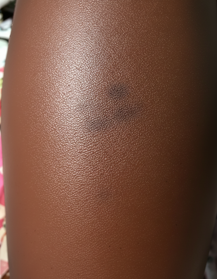 Dark marks (PIH) after