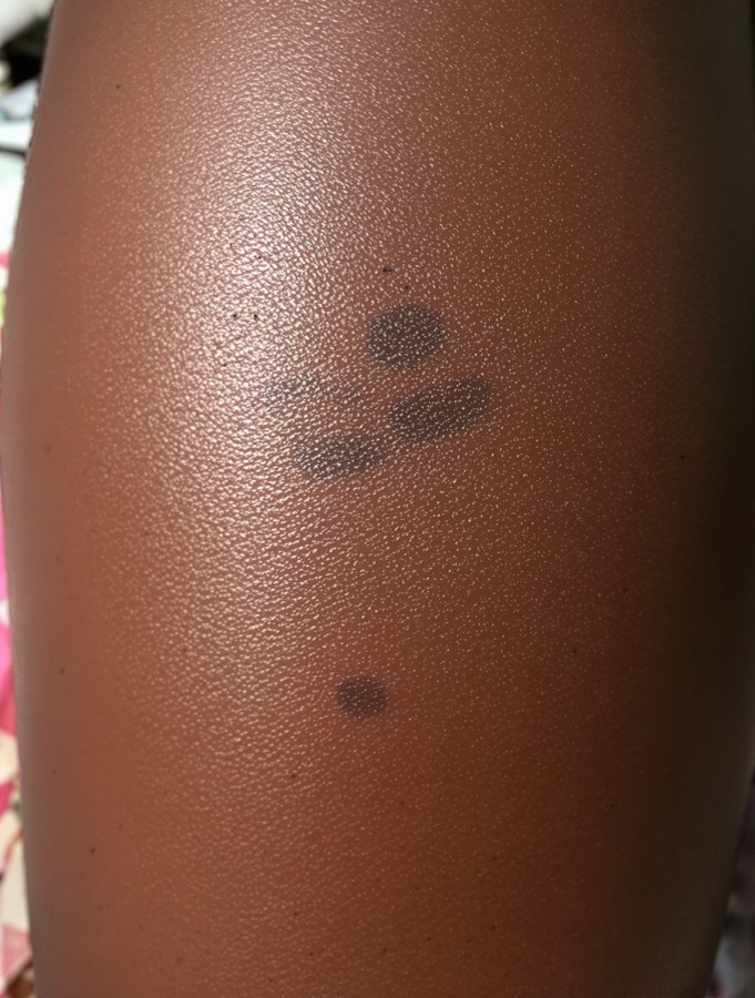 Dark marks (PIH) before