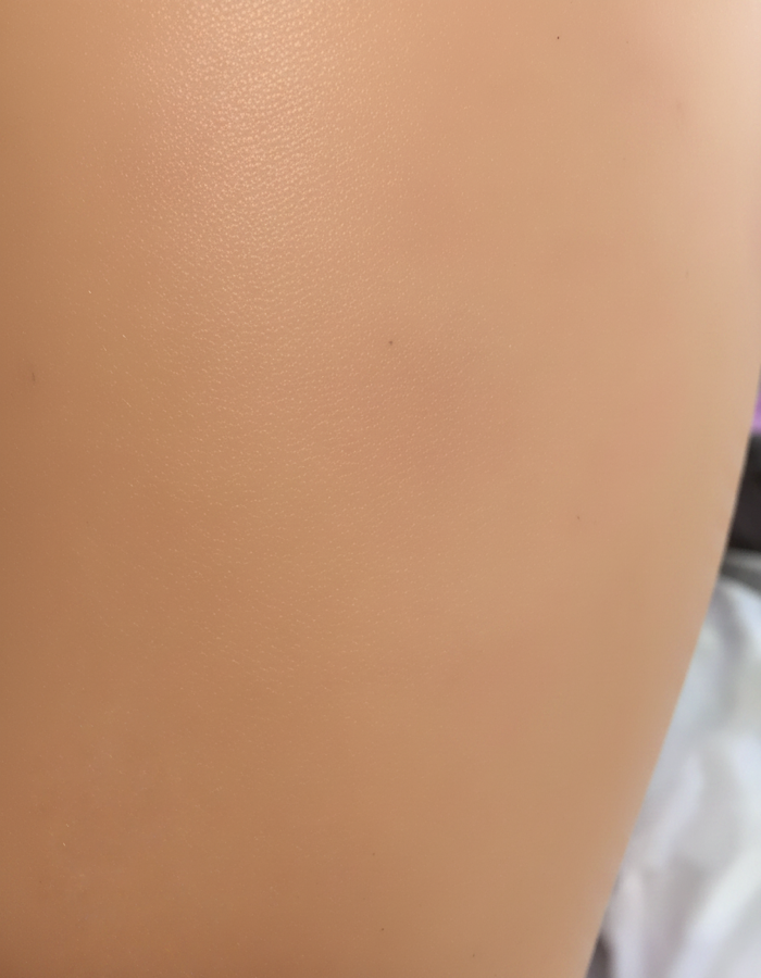 Ingrown hairs after