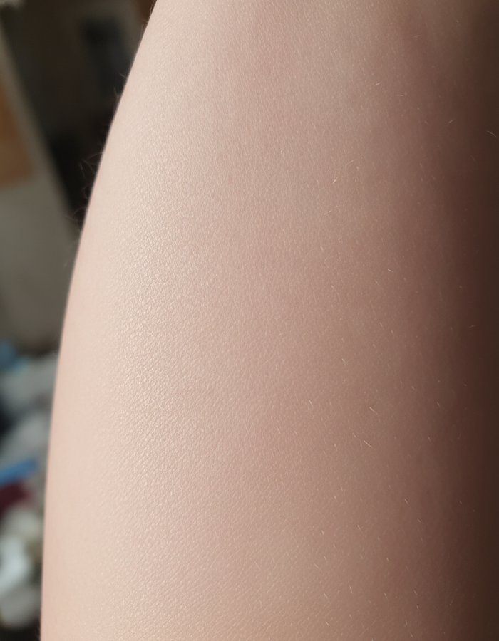 Keratosis pilaris after