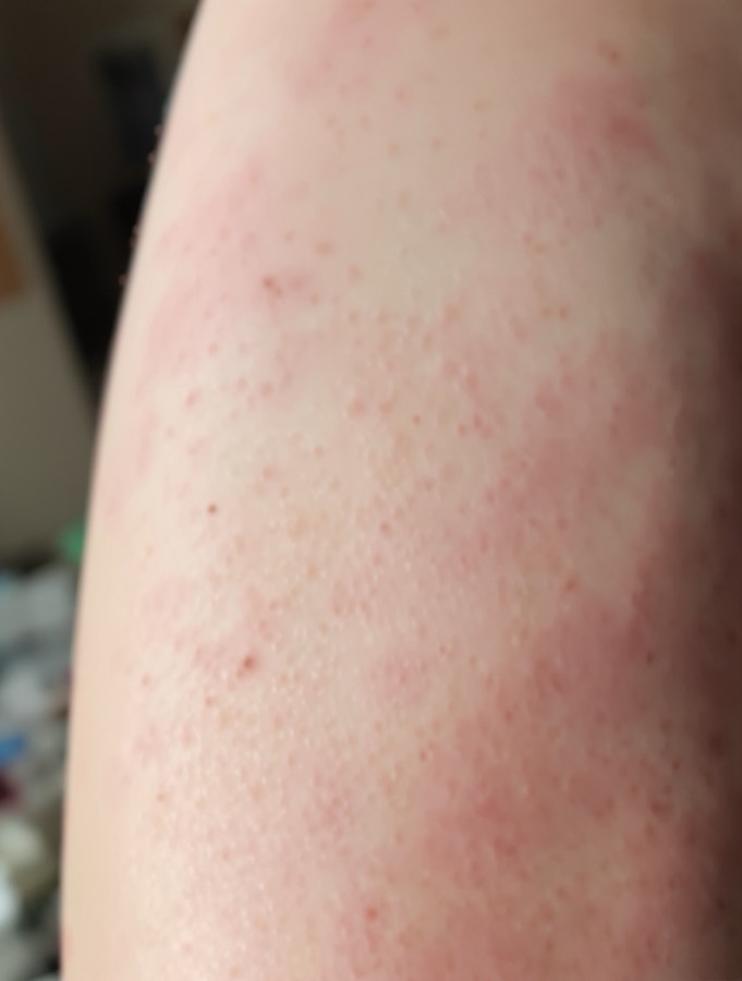 Keratosis pilaris before