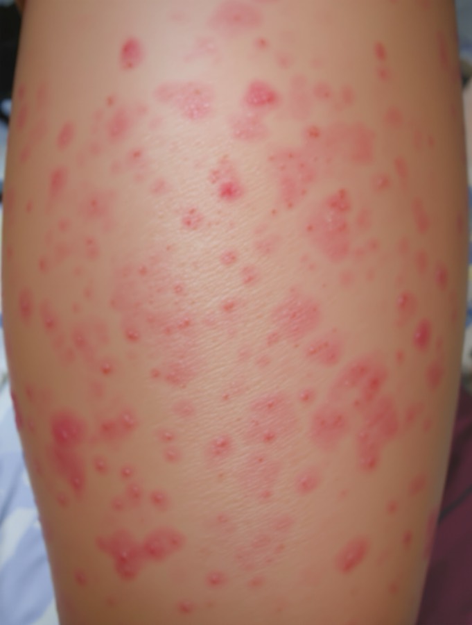 Razor bumps before